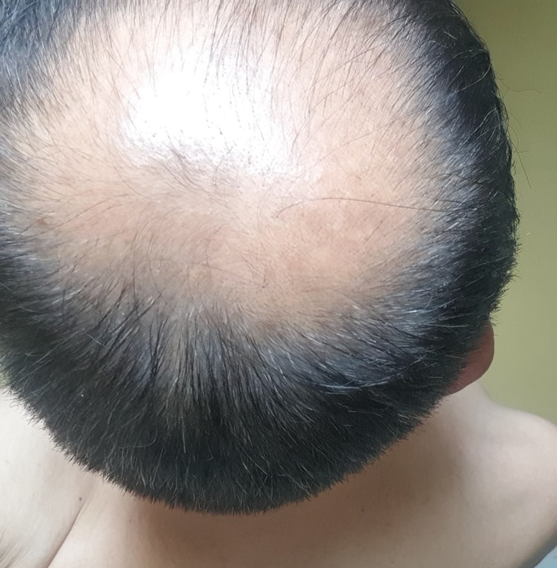 정수리 모발이식 1900모낭 모원성형외과 4개월
