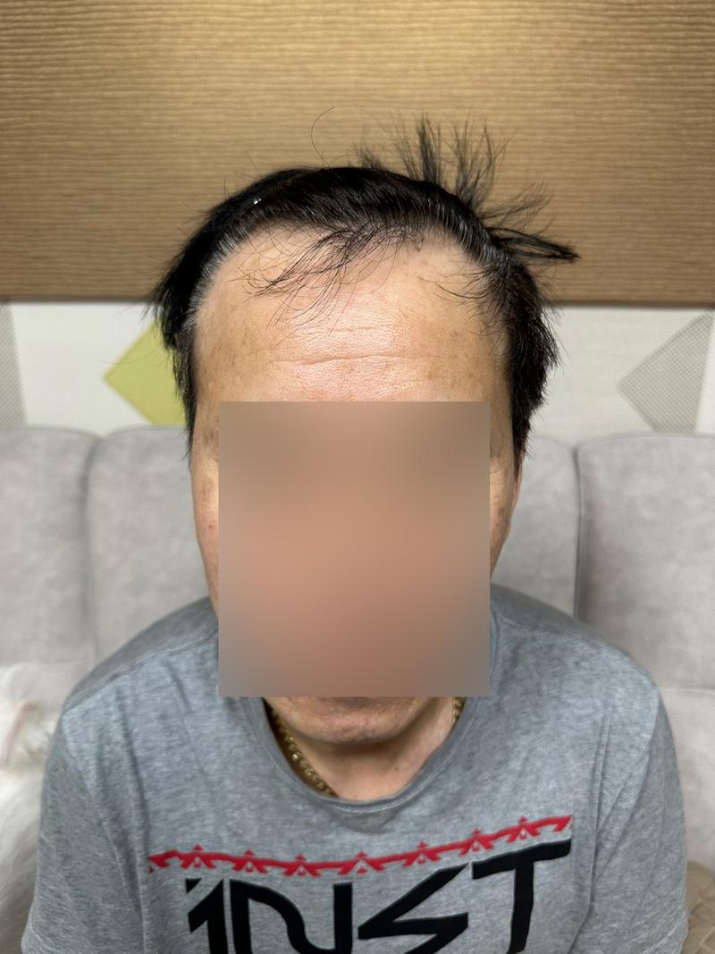 丸刈り費切開 ヘアライン、頭頂部毛髪移植7ヵ月目のモウォン整形外科
