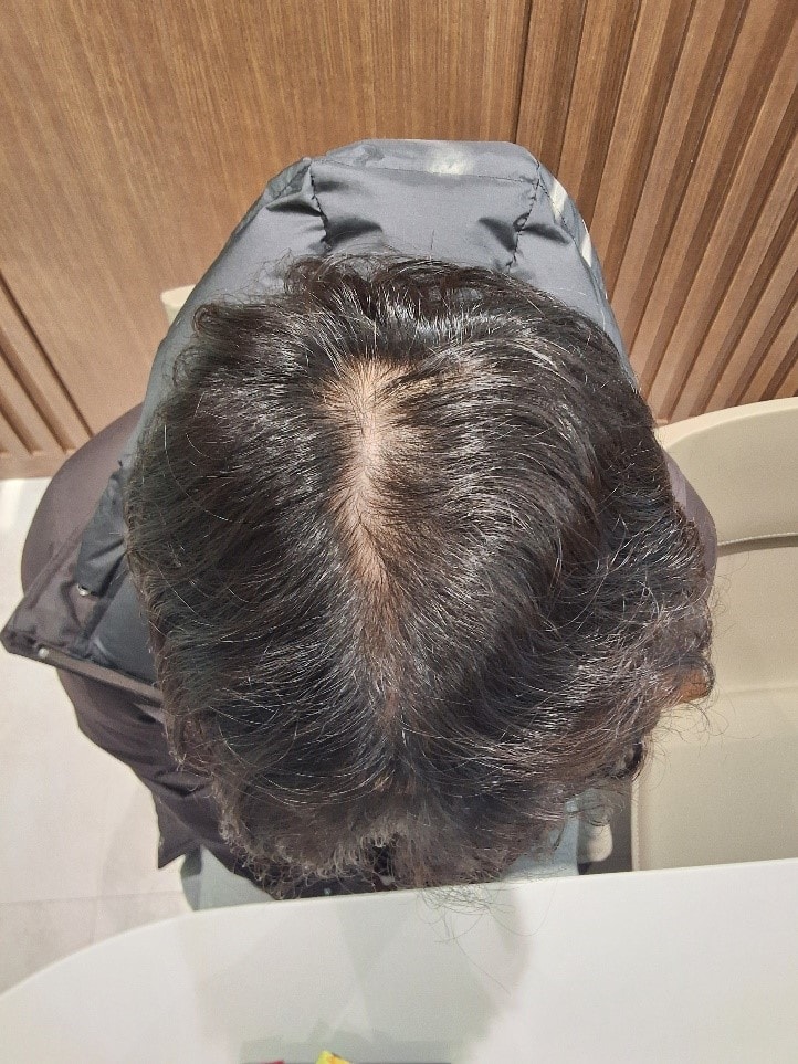 가르마모발이식+가르마 두피문신 7개월차 모원성형외과