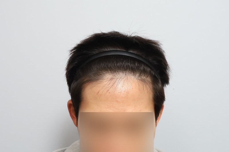 M자 헤어라인 비절개 모발이식 1일차 모원성형외과