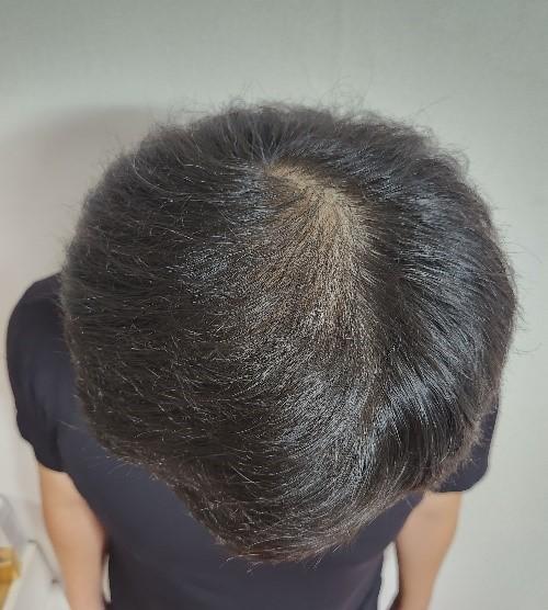 ヘアライン、頭頂部 非切開 毛髪移植 7ヶ月 モウォン整形外科