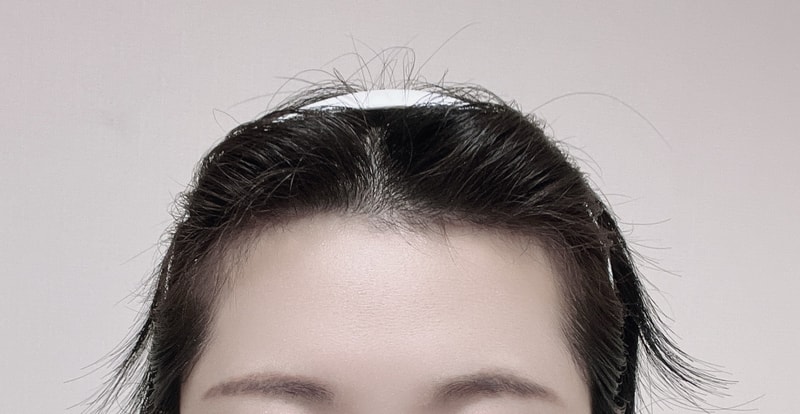 I'm writing a review of the first day of Mowon plastic surgery clinic's no-shave hairline