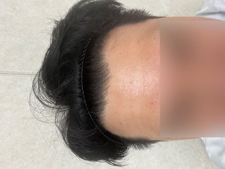 MOWON整形外科郑在洪院长的发际线毛发移植最早 4 个月经过
