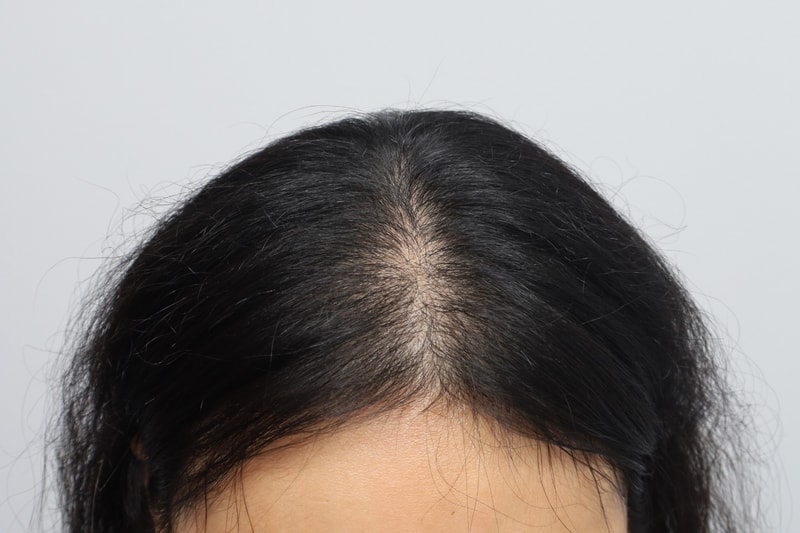 여자 정수리 전두부 무삭발비절개 1500모낭 4개월 모원성형외과