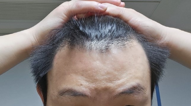 MOWON整形外科（郑在洪院长）请留下非切开两块头一个月后的后记
