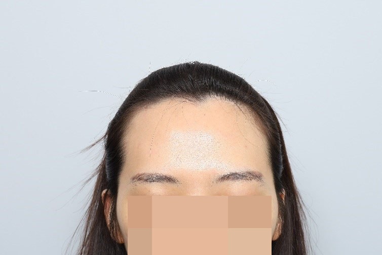 モウォン整形外科で部分削髪ヘアライン毛髪移植を受けてきました ~ (1日目、パク·ジョンオク院長)