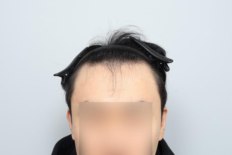 Mザイマ ヘアライン 1200毛包 非切開 毛髪移植+頭頂部頭皮タトゥー 当日の後、モウォン整形外科