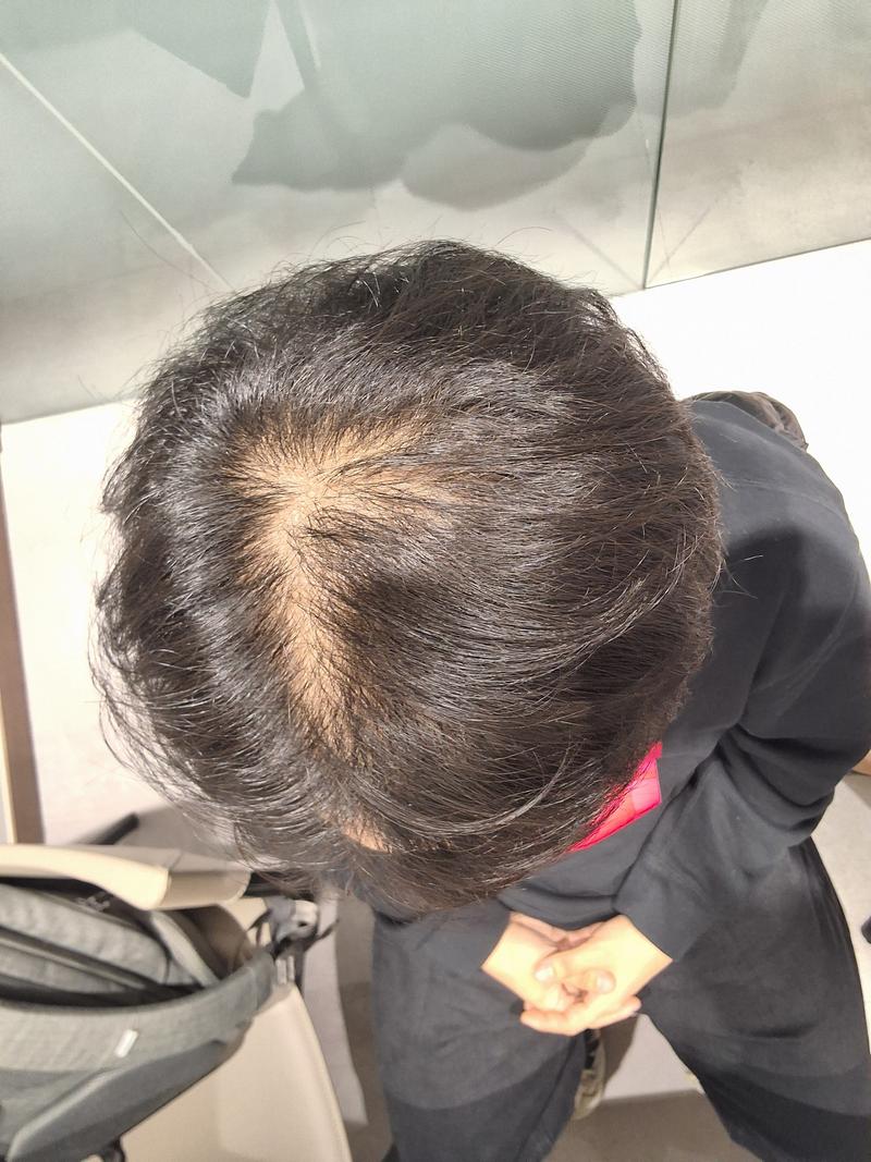 Head hair lossless cut non-cut hair transplant 2000 hair follicle hair original plastic surgery doctor Jeong Jae-hong