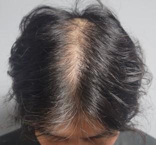 分け目ライン部分削髪非切開毛髪移植7ヶ月モウォン整形外科