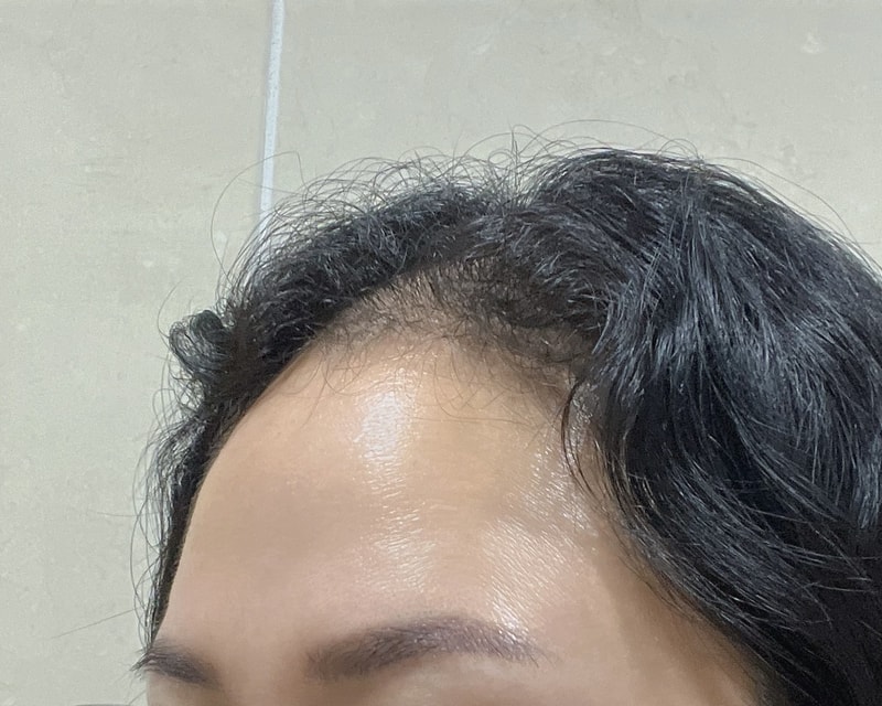 モウォン整形外科 ヘアライン手術当日と翌日のレビュー