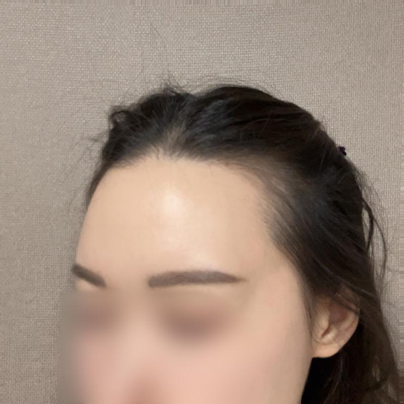 M Zaima Women's Hairline Hair Transplantation 3 Months Mo Won Plastic Surgery