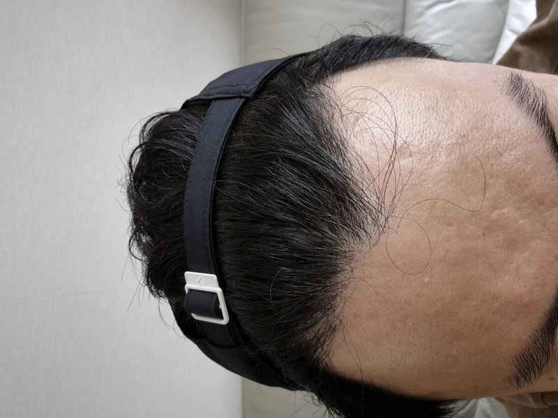 接受MOWON整形外科朴钟玉（音）院长的1222毛囊毛发移植（再手术）已经11天了。