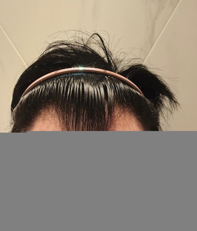 Mawon Plastic Surgery M Zaima Two Block Non-Cutted Hair Transplantation for 4 months
