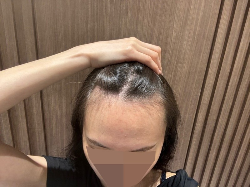 모원성형외과 여자헤어라인 1300모낭 무삭발모발이식 12개월! 완전 깔끔해요!