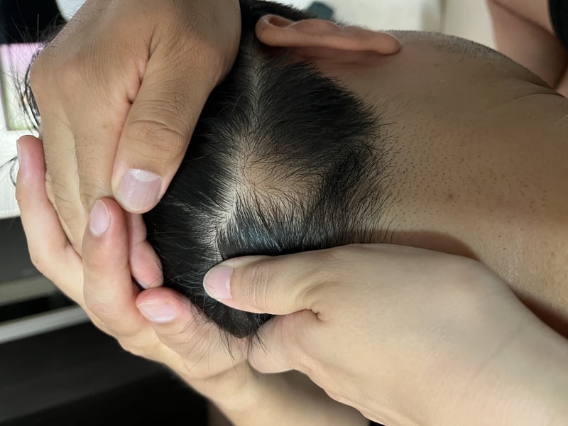 Solving the problem that's been tied for 40 years! Director Jeong Jae-hong, 3-month-old surgery clinic for scar hair transplantation