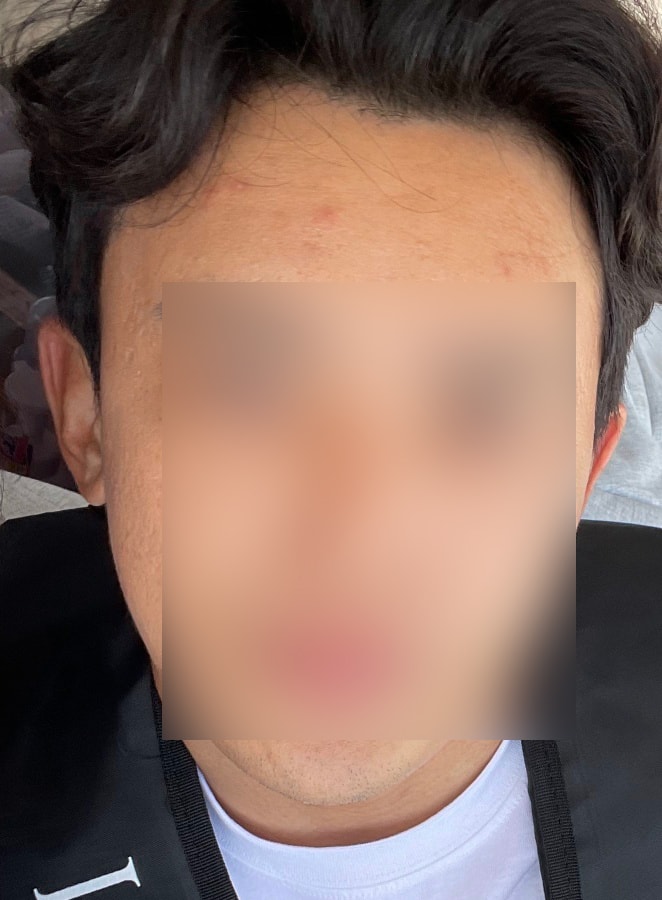I'm posting a review of 1300 hair follicles in Mowon plastic surgery surgery.