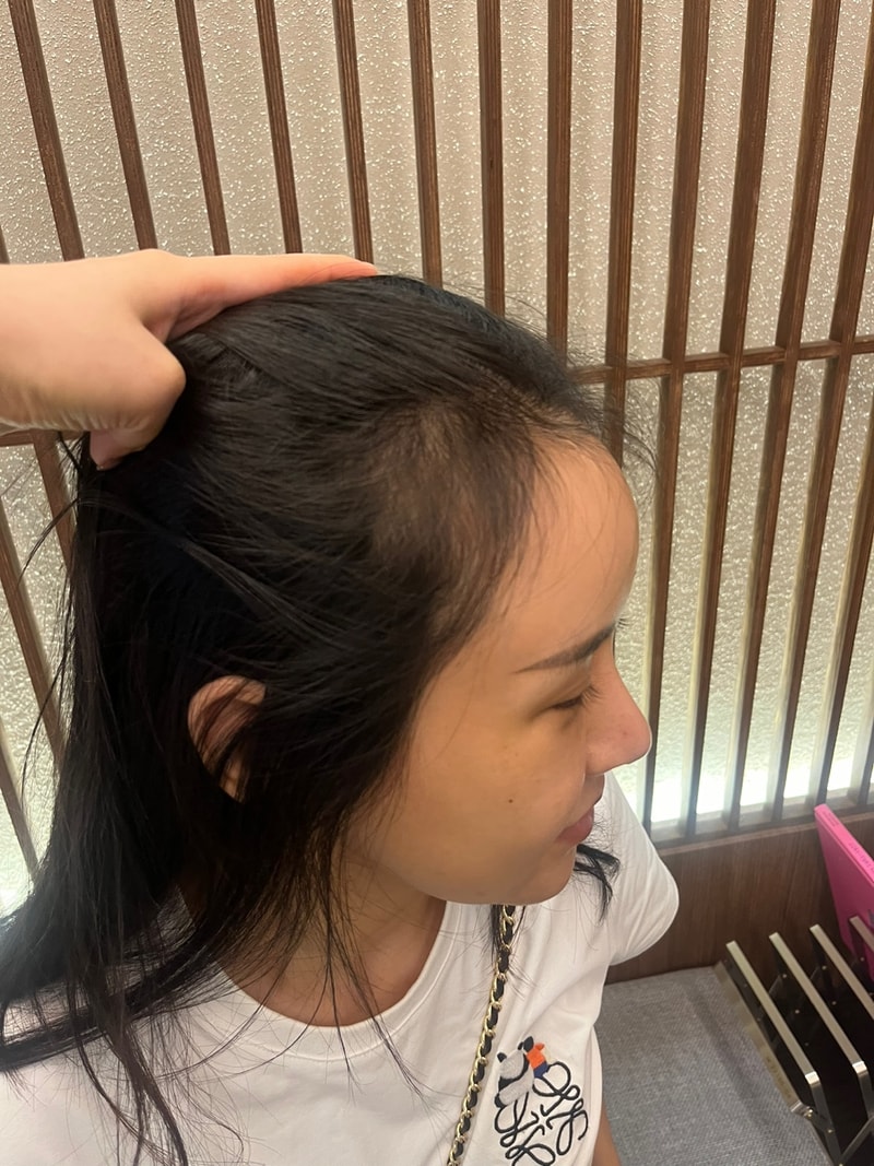 모원성형외과에서 헤어라인 부분삭발 비절개 모발이식 받은지 1년이 지났네요^^