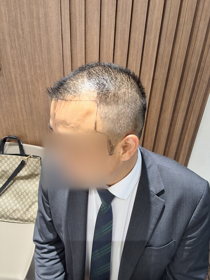 I had a hair transplant for M.J. at M.M. Plastic Surgery