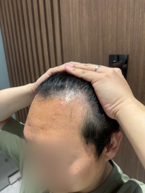 非切開毛髪移植10日目の後期、モウォン整形外科のチョン·ジェホン院長