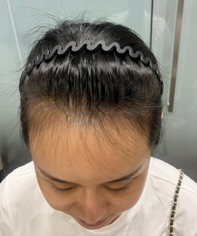 I solved the problem with the hairline by cutting it