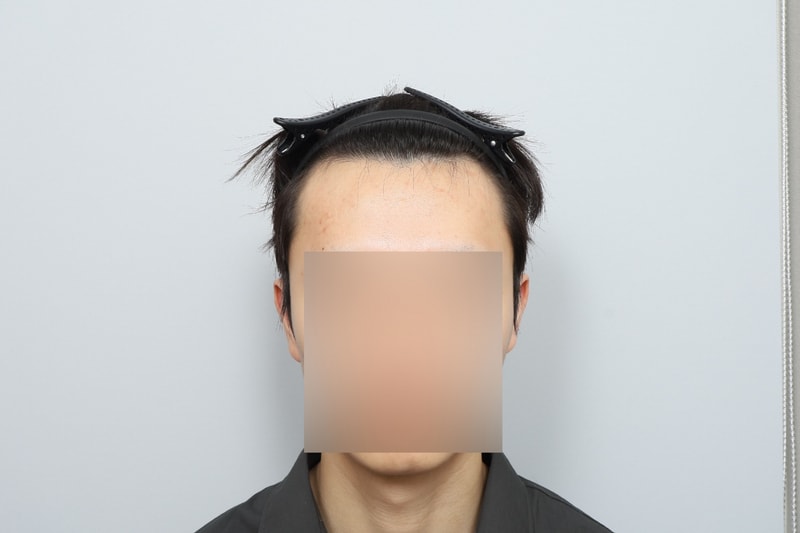 05년생 남자 비절개 모발이식 2주차 모원성형외과