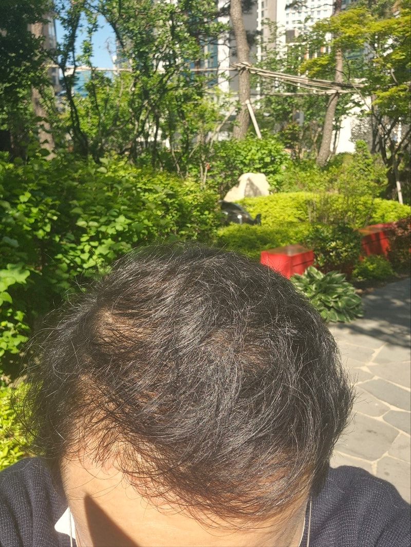 頭頂部の前頭部毛髪移植7日目のモウォン整形外科のチョン·ジェホン院長