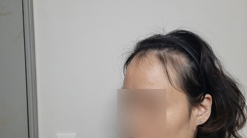모원성형외과에서 무삭발 헤어라인 모발이식 4개월차입니다