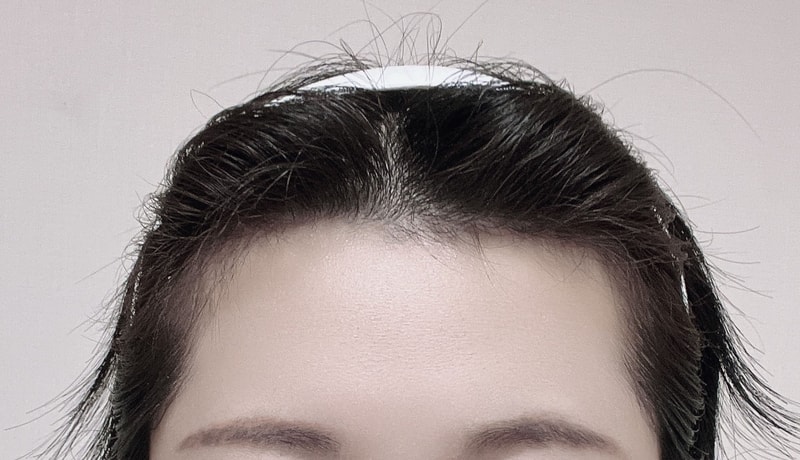 It's the 8th day review of the hairline! (Mother's Plastic Surgery)