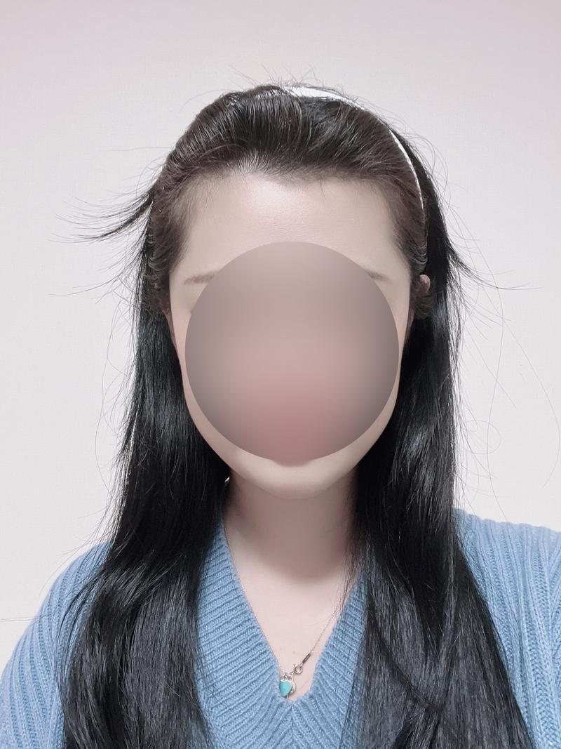 Mawon Plastic Surgery Women's Hairline Non-Cutting Hair Transplantation 7 Months + Parting Line Tattoo Review
