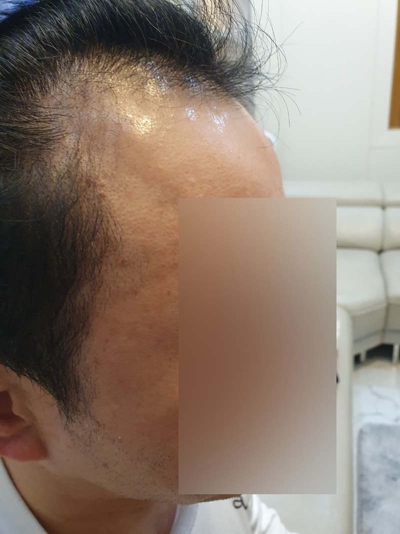 엠자탈모 무삭발 롱헤어 비절개 모발이식 5일차 모원성형외과