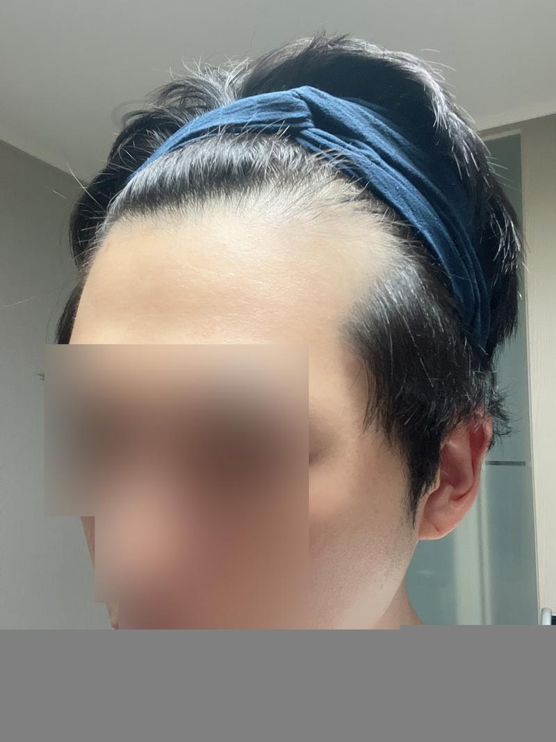 무삭발 비절개모발이식 + 두피문신 10일 후기 모원성형외과