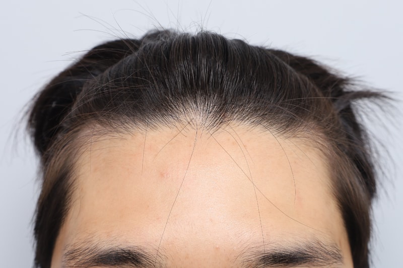 無削髪 ヘアライン 毛髪移植 800毛包 14日目 毛源 整形外科