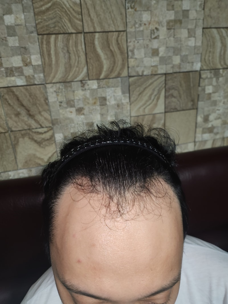 Mowon Plastic Surgery (Director Jeong Jae-hong) I'm posting the review of the first day of the no-cut incision. lol