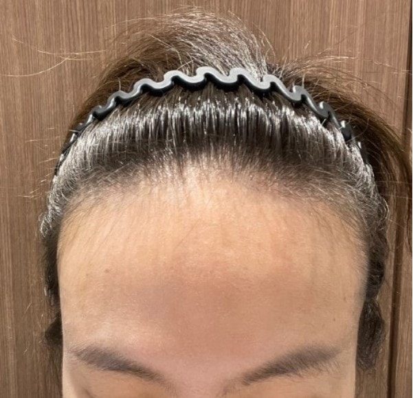Mowon Plastic Surgery Hairline Correction Non-Cutting Part 12 Day <Director Park Jong-ok>