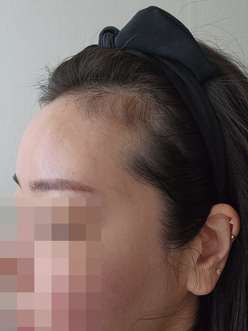 모원성형외과 헤어라인모발이식 마침내 1년!! 박종옥원장님