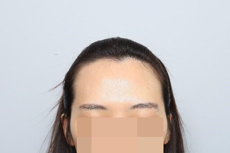 モウォン整形外科 部分剃髪 女性ヘアライン 毛髪移植 7ヶ月