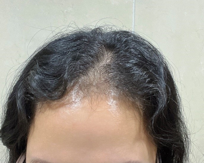 モウォン整形外科(パク·ジョンオク院長) 非切開部分の剃髪、ヘアライン1ヵ月目のレビューを書いてみましょう~