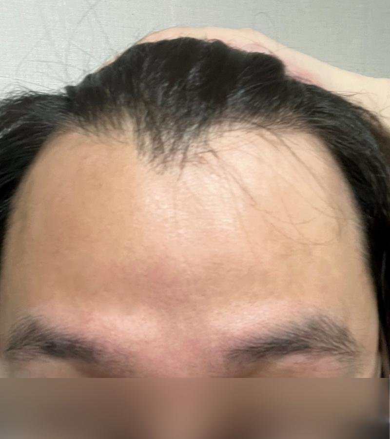 モウォン整形外科 エムジャヘアライン 毛髪移植 7ヶ月
