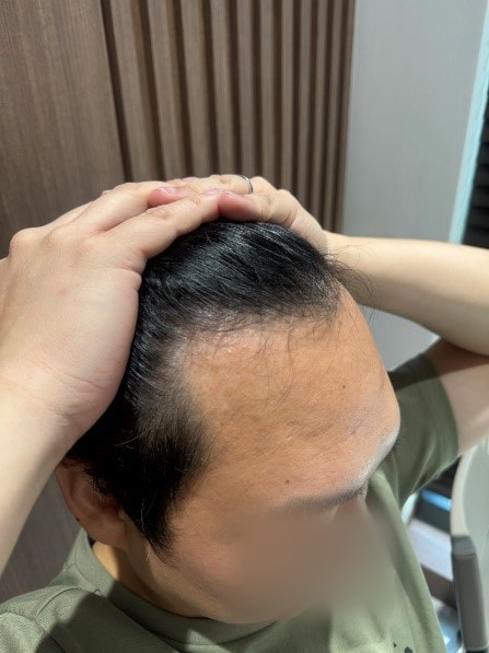 비절개모발이식 1년 후기 모원성형외과 정재홍원장님