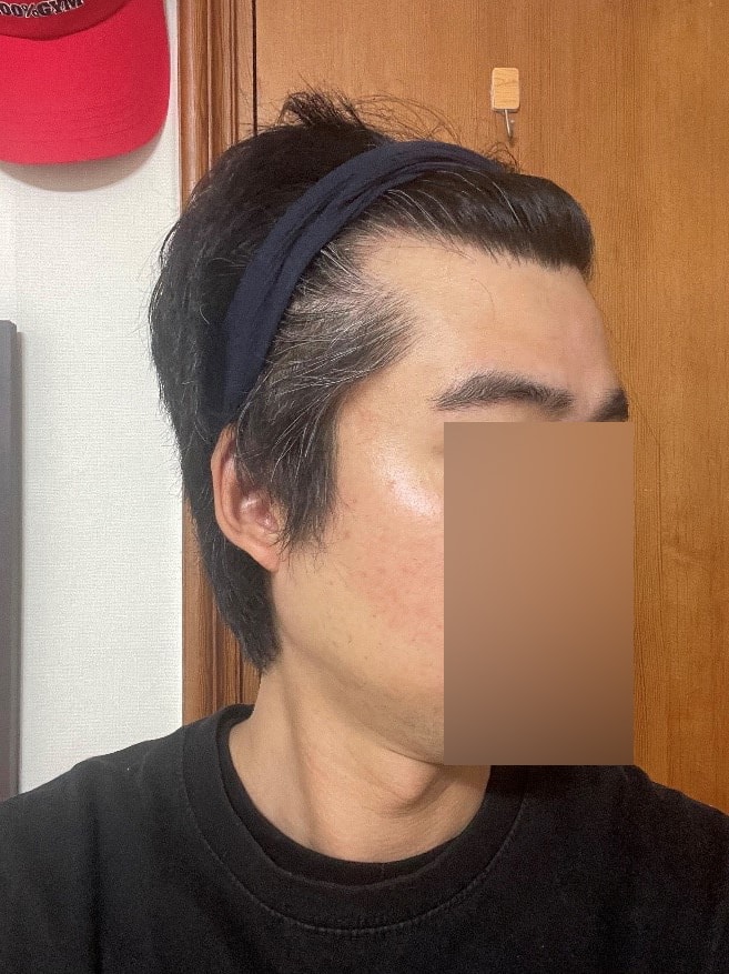정수리+M자 헤어라인 모발이식 1년차 모원성형외과 정재홍원장님