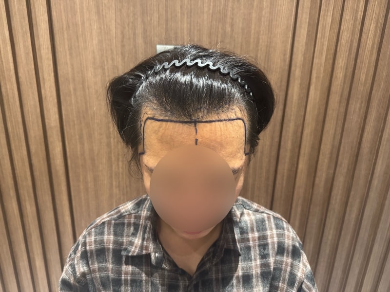 모원성형외과 남자 무삭발 모발이식 2200모낭 2일차 후기..