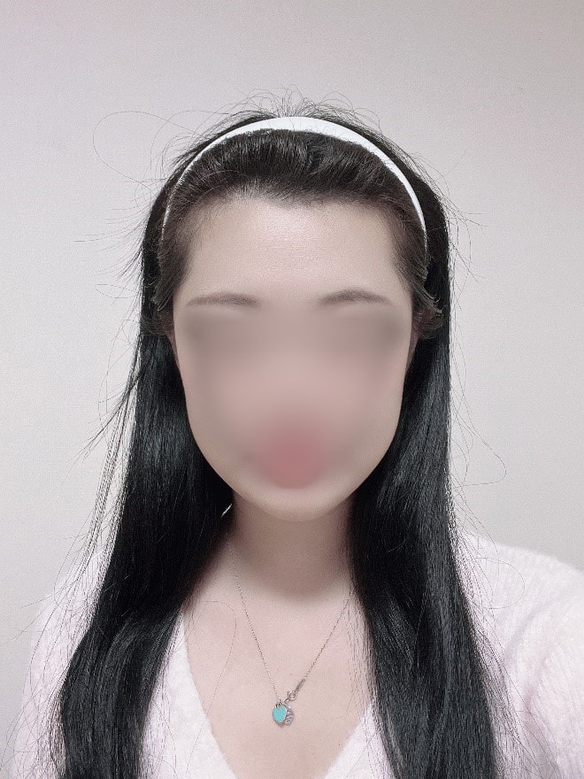 모원성형외과 여자헤어라인 비절개모발이식 12개월