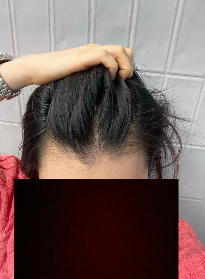 모원성형외과 무삭발 비절개 헤어라인 모발이식 1600모낭 4개월차
