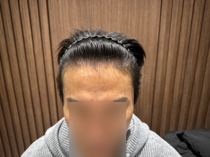 MO.1成形外科医院ヘアライン 非切開毛髪移植 7ヶ月目です。