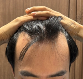 Mowon Plastic Surgery M Zaima Non-Sectional Hair Transplantation 2022 Hair Orphanage 3 Months