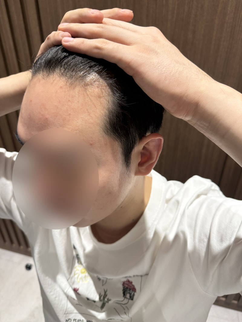 모원성형외과 1700모낭 비절개 모발이식 6일차 후기