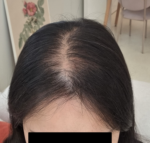 출산과 함께 찾아온 탈모 고민 해결했어요 부분삭발 비절개(5일차)