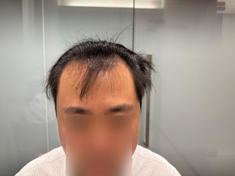 무삭발 비절개 모발이식 모원성형외과 M자탈모 4개월