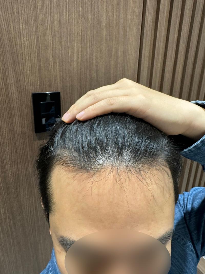 M-shaped non-cut hair transplant on the 10th, Mo Won Plastic Surgery