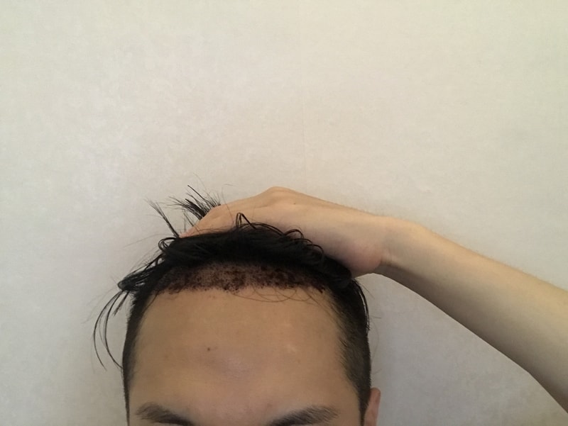수술 후 3일차 입니다.